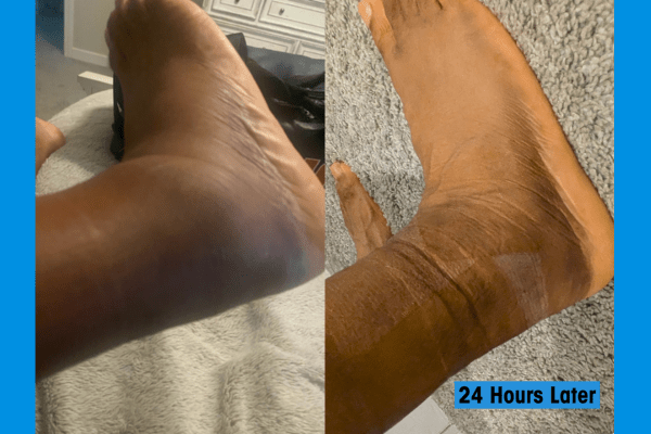 ActivMend: Reducing Swelling for Basketball Players with Sprained Ankles - ActivMend