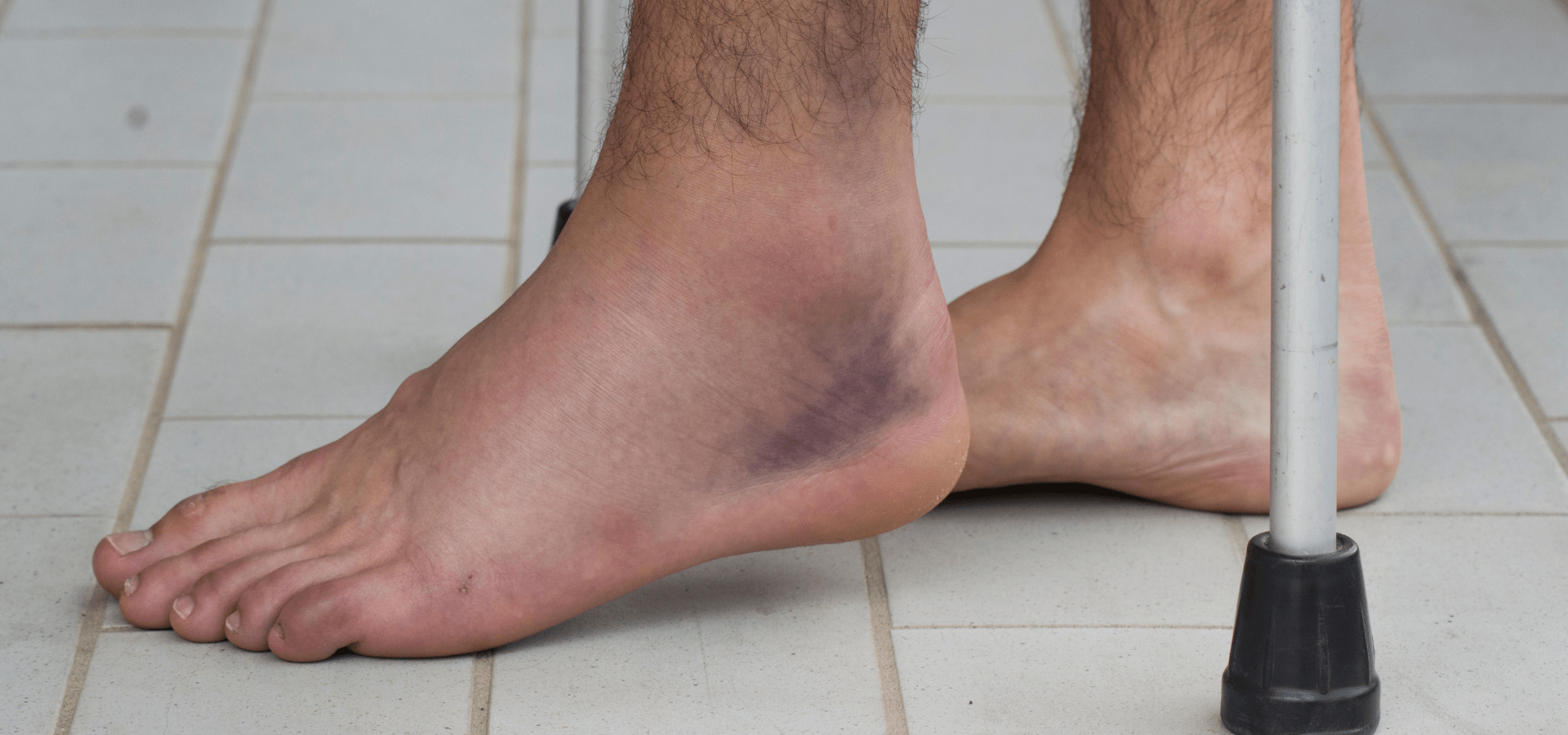 When Swelling Gets Worse Before It Gets Better: What It Means with ActivMend? - ActivMend