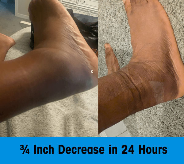 ActivMend - 2X Faster Recovery from Ankle Sprains - ActivMend